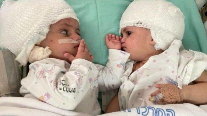 Σπάνια εγχείρηση – Σιαμαία ενωμένα στο κεφάλι κοιτάχτηκαν για πρώτη φορά