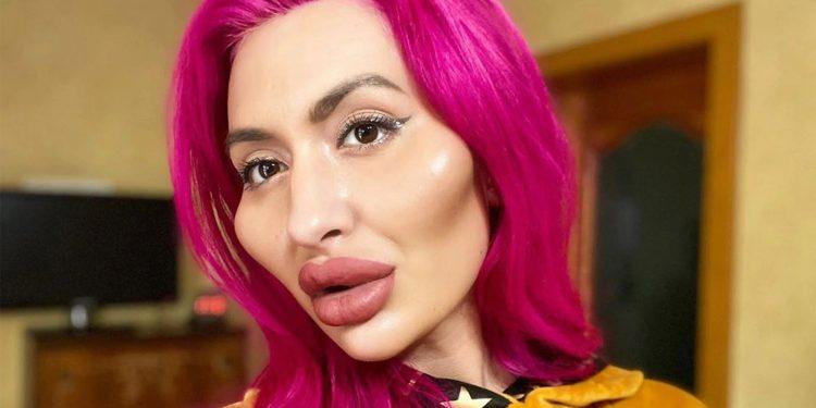 Η γυναίκα «με τα μεγαλύτερα μάγουλα στον κόσμο» αύξησε ξανά το μέγεθος: «Τα λατρεύω»