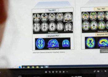 Η FDA ενέκρινε φάρμακο που επιβραδύνει την εξέλιξη της νόσου Αλτσχάιμερ