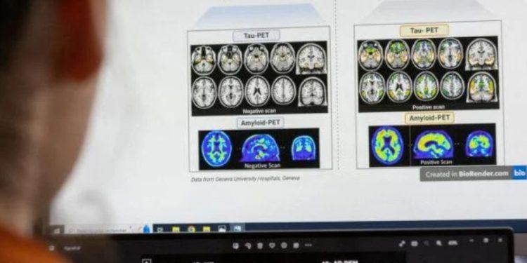 Η FDA ενέκρινε φάρμακο που επιβραδύνει την εξέλιξη της νόσου Αλτσχάιμερ