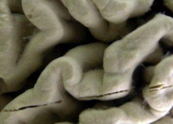 Αλτσχάιμερ: Νέο φάρμακο επιβραδύνει την εξέλιξη της νόσου