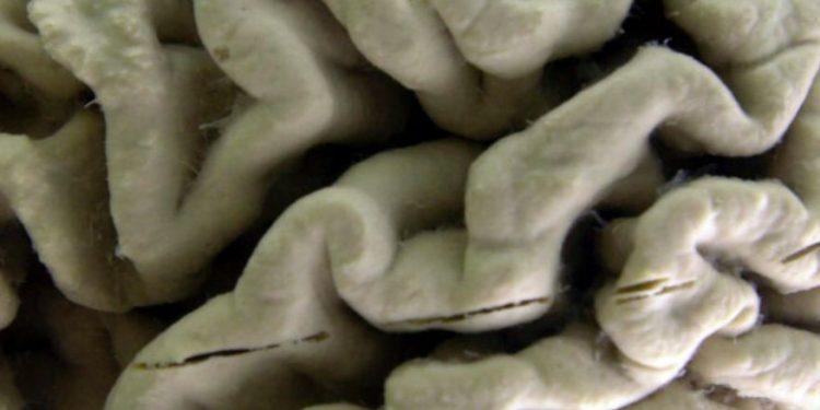 Αλτσχάιμερ: Νέο φάρμακο επιβραδύνει την εξέλιξη της νόσου