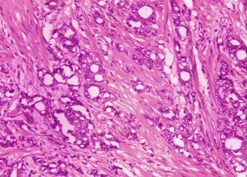 Τα κρούσματα καρκίνου του προστάτη θα αυξηθούν σημαντικά, προβλέπει μελέτη