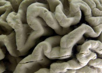 Τμήμα ανθρώπινου εγκεφάλου με νόσο Αλτσχάιμερ εκτίθεται στο Μουσείο Νευροανατομίας του Πανεπιστημίου του Μπάφαλο, στη Νέα Υόρκη, 7 Οκτωβρίου 2003.(APPhoto/DavidDuprey, αρχείο)