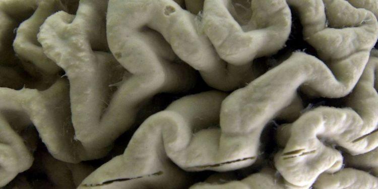 Τμήμα ανθρώπινου εγκεφάλου με νόσο Αλτσχάιμερ εκτίθεται στο Μουσείο Νευροανατομίας του Πανεπιστημίου του Μπάφαλο, στη Νέα Υόρκη, 7 Οκτωβρίου 2003.(APPhoto/DavidDuprey, αρχείο)